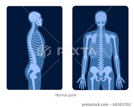 Spine X ray 68363702
