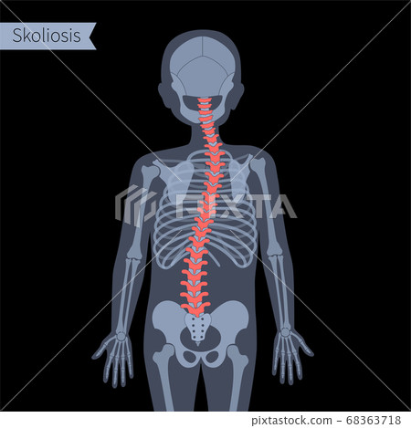 Spine X ray 68363718