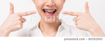 Face of a young smiling asian woman with braces on teeth, Orthodontic Treatment. Face of a young smiling asian woman with braces on teeth, Orthodontic Treatment. 68382083
