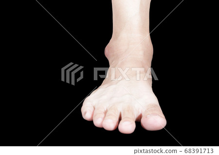 Astragalus is swollen Astragalus is swollen 68391713