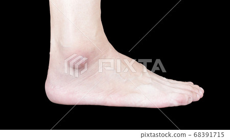 Astragalus is swollen 68391715