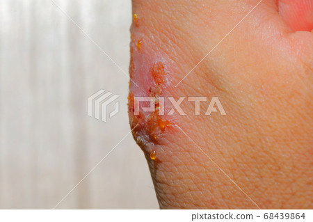 Skin cells of the hand of a severe allergic patient with suppurated wound 68439864