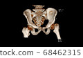 Computed Tomography Volume Rendering examination of the  pelvis showing left femur neck fracture ( CT VR Pelvis).Radiology examination Computed Tomography Volume Rendering examination of the  pelvis showing left femur neck fracture ( CT VR Pelvis).Radiology examination 68462315