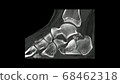 Computed Tomography  of the  foot in sagittal plane showing fracture of  calcaneum/ heel bone ( CT Foot).Radiology examination Computed Tomography  of the  foot in sagittal plane showing fracture of  calcaneum/ heel bone ( CT Foot).Radiology examination 68462318