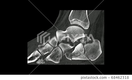 Computed Tomography Of The Foot In Sagittal Stock Illustration 68462318 Pixta