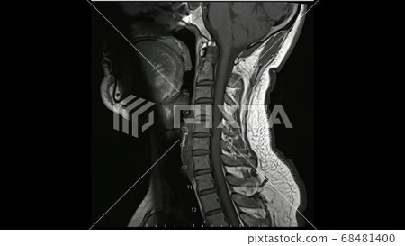 Magnetic Resonance images of Cervical spine sagittal T1-weighted images (MRI Cervical spine) showing Multiple disc disease, more evident at C5-6 disc. Magnetic Resonance images of Cervical spine sagittal T1-weighted images (MRI Cervical spine) showing Multiple disc disease, more evident at C5-6 disc. 68481400