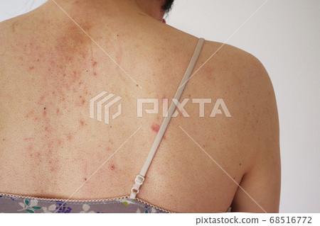 The back of a man suffering from gender identity disorder immediately after medical hair loss The back of a man suffering from gender identity disorder immediately after medical hair loss 68516772