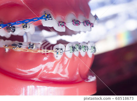 Dental brackets teeth straighteners Dental brackets teeth straighteners 68518673