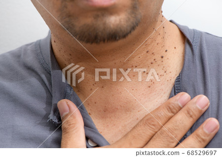 Closed up the Skin Tags or Acrochordon on neck man 68529697