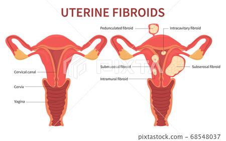 Woman uterine fibroids diagram on white background Woman uterine fibroids diagram on white background 68548037