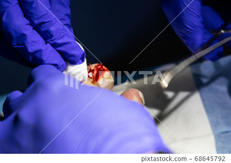 Series of ingrown toenail treatment. Medical Series of ingrown toenail treatment. Medical 68645792