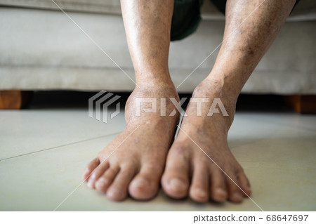 Asian senior woman is show her swollen feet or legs in the area of astragalus,elderly patient with astragalus swelling,ankle bone pain,tendinitis,chronic bursitis,caused by the accident,health care  68647697