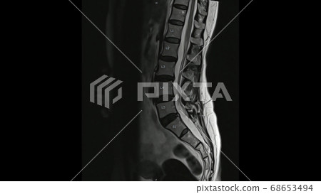 Magnetic Resonance images of Lumbar spine sagittal T2-weighted images (MRI Lumbar spine) showing mild disc disease. Magnetic Resonance images of Lumbar spine sagittal T2-weighted images (MRI Lumbar spine) showing mild disc disease. 68653494
