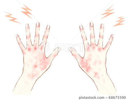 Redness on the back of the hand 68673390