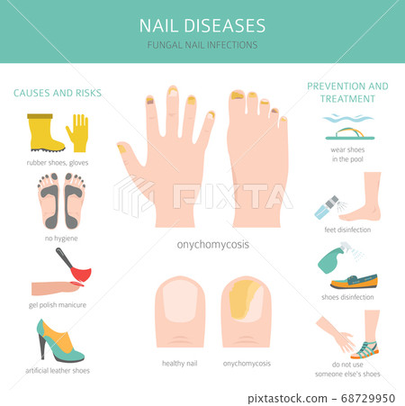 Close up of fungus nail infection. Fungal infection on nails hand, finger  with onychomycosis, damage on human hand on gray concrete wall background.  Disease and Symptom concept. Stock Photo | Adobe Stock