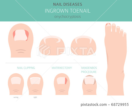 Nail diseases. Onychocryptocosis, ingrown toenail. Nail diseases. Onychocryptocosis, ingrown toenail. 68729955