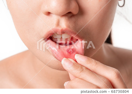 Asian women have aphthous ulcers on mouth on white Asian women have aphthous ulcers on mouth on white 68730804