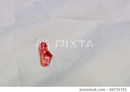 Closeup of extracted ingrown toenail on piece of Closeup of extracted ingrown toenail on piece of 68735781