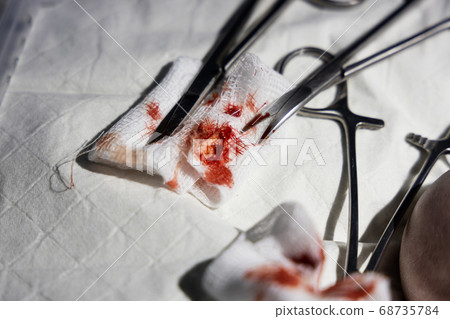 Extracted ingrown toenail with blood on gauze 68735784
