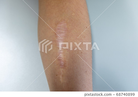 tissue, scar, fibrous 68740899