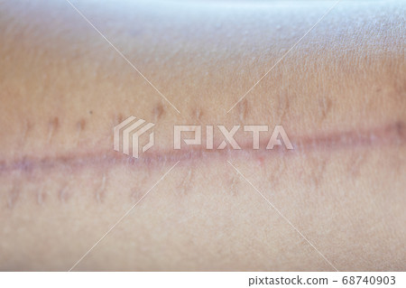 tissue, scar, fibrous 68740903