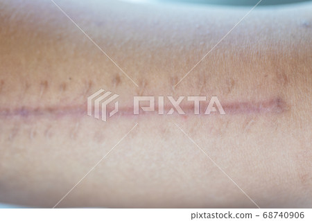 arm, pain, wound 68740906