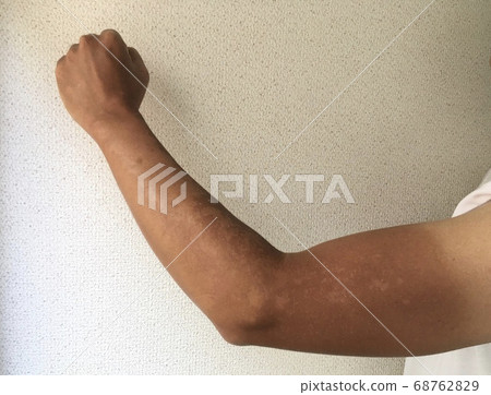 T-shirt on a burnt man's arm 68762829