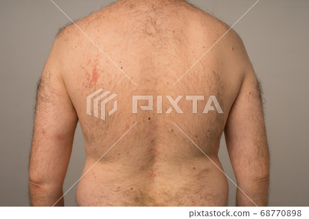 Allergy reaction is red spots on the body of a Allergy reaction is red spots on the body of a 68770898