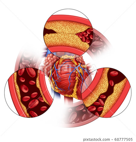 Heart Artery Disease Heart Artery Disease 68777505