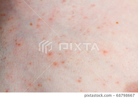 Close up image of a little boy's body suffering severe urticaria, nettle rash also called hives 68798667