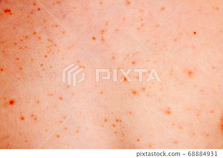 Close up image of a little boy's body suffering severe urticaria, nettle rash also called hives 68884931