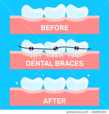 Cartoon teeth vector illustration, before and after brace correction. Concept of ortodontic treatment. Stages of dental alighment. 68896369
