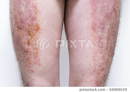 Severe eczema with pus Severe eczema with pus 68906039