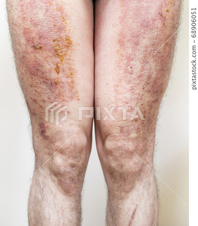 Severe eczema with pus Severe eczema with pus 68906051