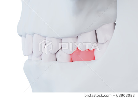 human jaw with a sore tooth, red lower sixth molar human jaw with a sore tooth, red lower sixth molar 68908088