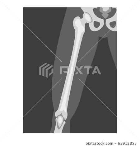 Roentgenograph of Upper Leg Front View Vector Image 68912855