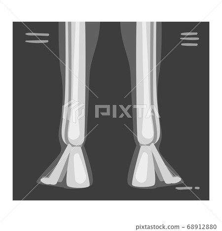 Roentgenograph of Lower Leg Back View Vector Image Roentgenograph of Lower Leg Back View Vector Image 68912880