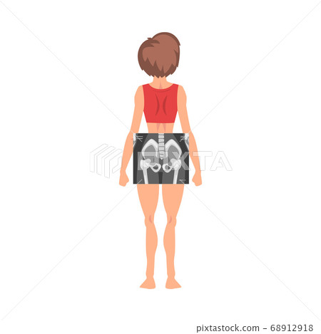 Female Thigh Bone Back View Roentgen Vector Illustration. Radiographic Procedure Concept Female Thigh Bone Back View Roentgen Vector Illustration. Radiographic Procedure Concept 68912918