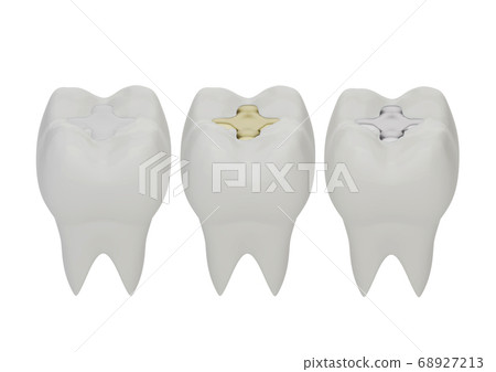 Teeth with gold, amalgam and composite inlay Teeth with gold, amalgam and composite inlay 68927213