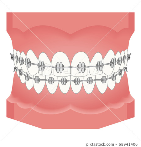 正畸器具 68941406