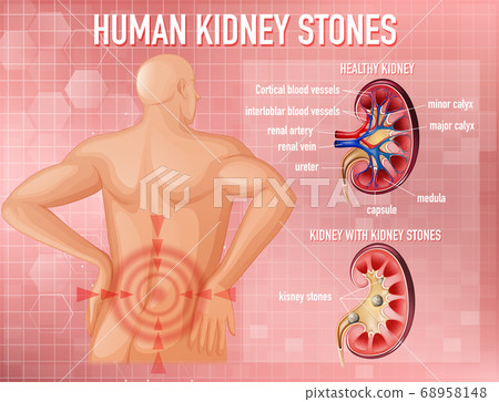 Informative illustration of kidney stones Informative illustration of kidney stones 68958148
