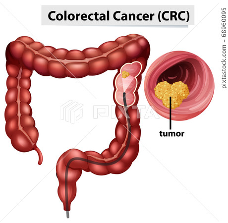Colorectal Cancer (CRC) infographic for education Colorectal Cancer (CRC) infographic for education 68960095