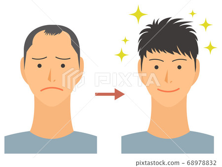 AGA禿頭矢量素材治療的一名男子的插圖 68978832