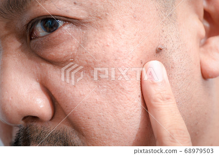 Closed up of big skin tags or Acrochordon on face Closed up of big skin tags or Acrochordon on face 68979503