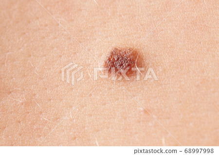 Birthmark on the skin of a person 68997998
