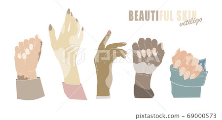 Hands with age spots or vitiligo isolated vector gestures genetic skin disease Hands with age spots or vitiligo isolated vector gestures genetic skin disease 69000573