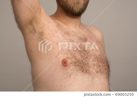 Allergy reaction is red spots on the body of a 69003250