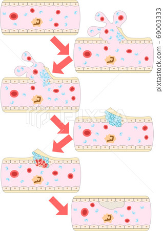 Human blood vessel repair illustration 2 69003333