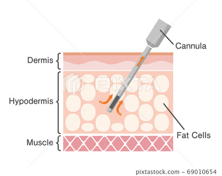 抽脂方法皮膚截面圖 美容 飲食 英語 插圖素材 圖庫