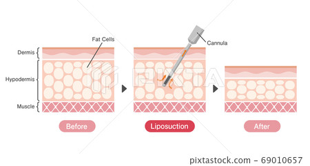 抽脂方法前後皮膚橫截面插圖 Beauty Diet 英語 插圖素材 圖庫